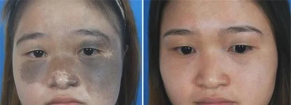 做E光治疗太田痣价格多少钱