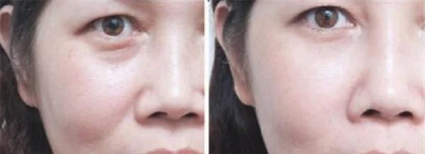 胶原蛋白去法令纹适合哪种人?