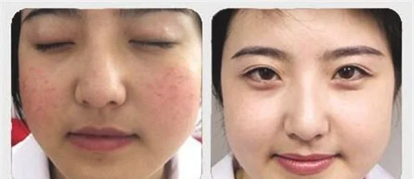 激光祛红血丝手术安全吗？