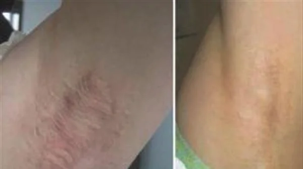 做剥离法去腋臭多少钱