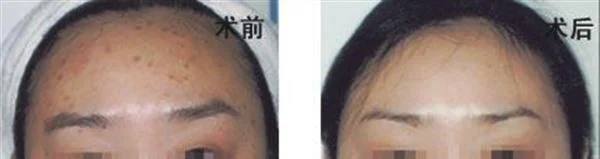 脉冲光去眉间纹手术注意事项是什么？