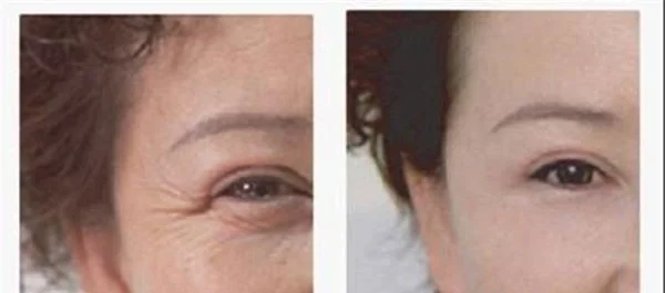 激光除鱼尾纹要多少钱？