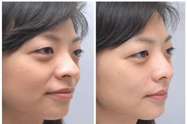 爱贝芙去法令纹手术术后护理?