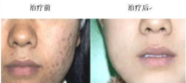 激光治疗痤疮手术注意事项是什么？