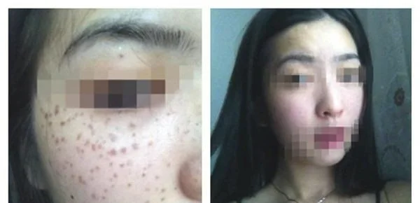 做化学剥脱祛斑价格