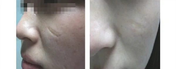 注射去疤多久能恢复？