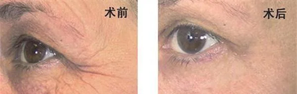 激光除鱼尾纹手术安全吗?