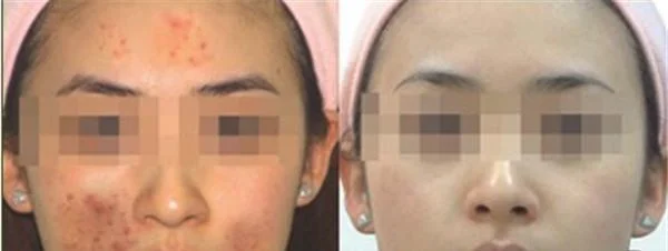 做袪青春痘价格多少钱