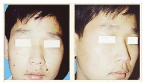 做E光点痣手术多少钱?