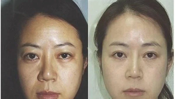 做射频去法令纹治疗效果怎么样？效果保持时间多久？