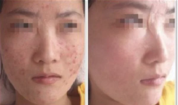 做激光治疗痤疮价格多少钱