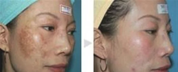 做E光治疗太田痣多少钱