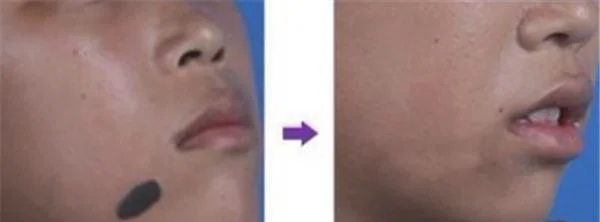 做切除手术去黑痣价格多少钱