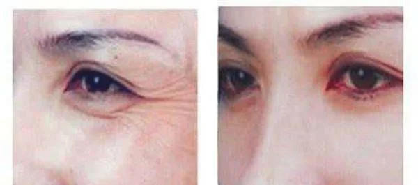 激光去眼角细纹效果如何?