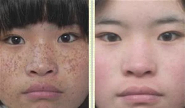 做冷冻法去雀斑价格