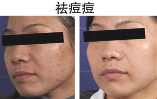 做激光去青春痘费用要多少