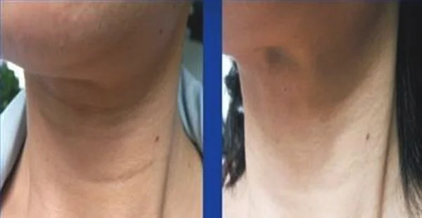 去颈纹失败修复手术的方法是什么?