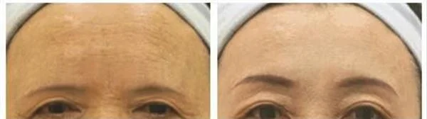 激光去除抬头纹手术安全吗?