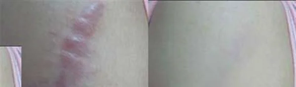 做冻疮疤痕修复治疗效果怎么样？效果保持时间多久？