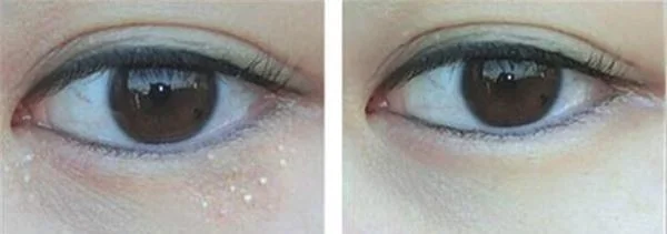 做去脂肪粒多少钱