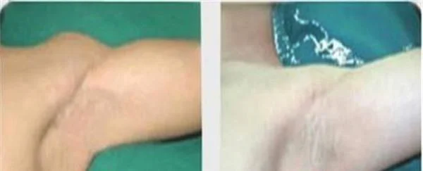 做激光去狐臭多少钱