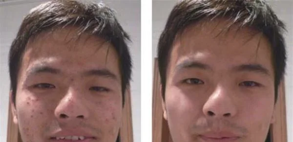 做切开填充治疗痘疤手术多少钱？