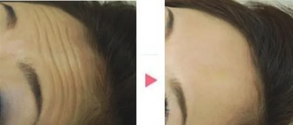 做小切口除皱去抬头纹手术多少钱？