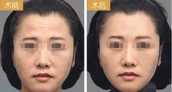 做爱贝芙去除抬头纹治疗效果怎么样？效果保持时间多久？