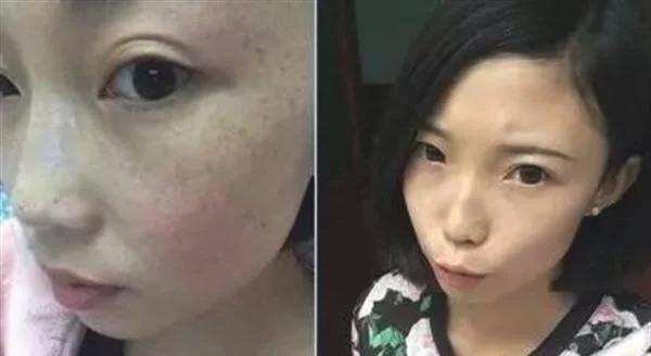 做去色斑手术多少钱？