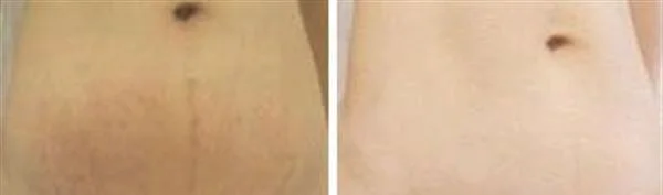 做微晶去妊娠纹治疗效果怎么样?效果保持时间多久?