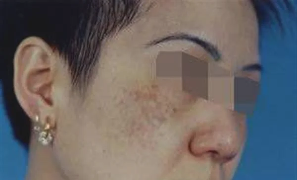 做冷冻法去黄褐斑价格要多少