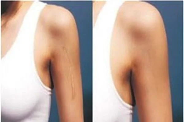 手术疤痕修复注意事项是什么?