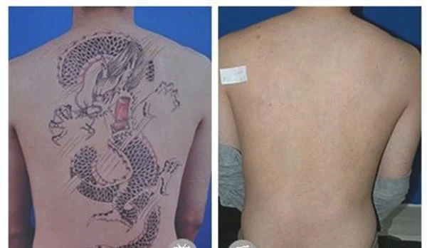 做洗纹身多少钱