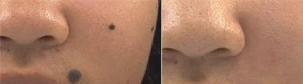 做化学剥脱点痣手术多少钱?