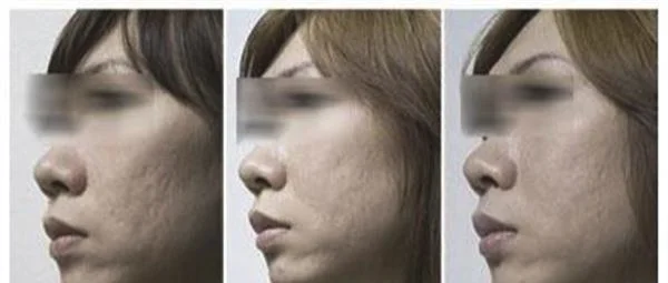 激光去痘疤手术注意事项是什么？