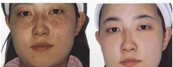 做彩光祛斑价格贵不贵