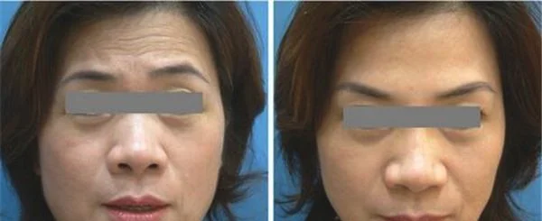 微晶磨皮去眼角细纹效果如何？
