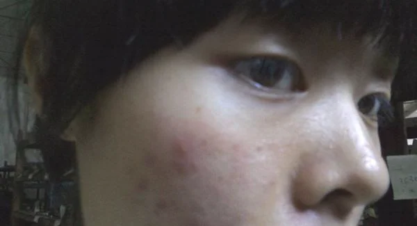 做激光去青春痘手术注意事项是什么？