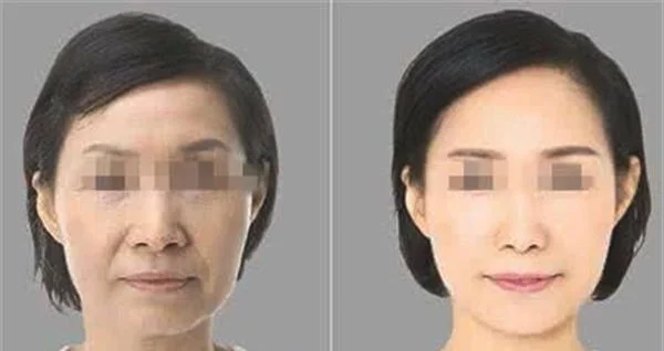 做水氧活肤治疗效果怎么样？效果保持时间多久？