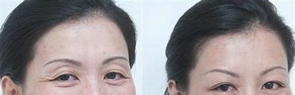 做额颞部除皱去鱼尾纹费用大概需要多少