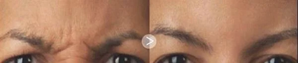 做爱贝芙去眉间纹手术多少钱？