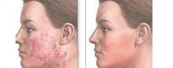 冷冻治疗去痘疤手术注意事项是什么？