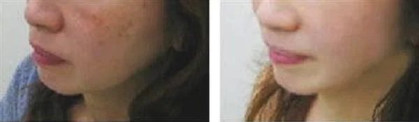 做微晶磨削去雀斑手术多少钱？