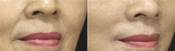 做胶原蛋白去法令纹治疗效果怎么样？效果保持时间多久？