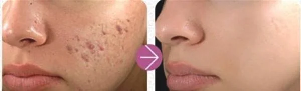 做针清去青春痘手术多少钱?