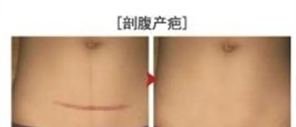 剖腹产疤痕修复手术效果好不好?