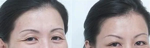 微晶磨皮去鱼尾纹手术注意事项是什么？