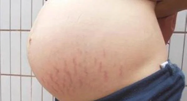 做激光去妊娠纹价格是多少