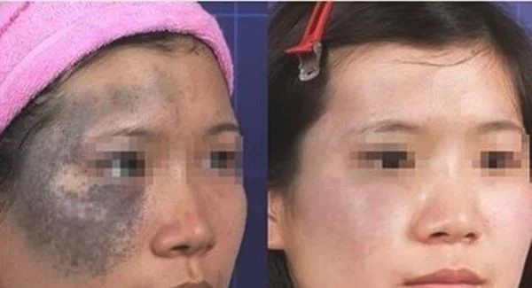 做激光去太田痣手术时间是多久？