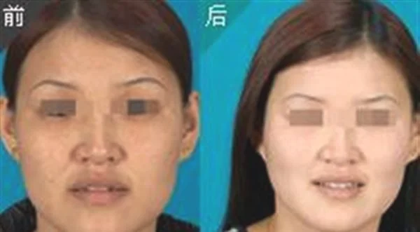 激光除眉间纹手术安全吗？